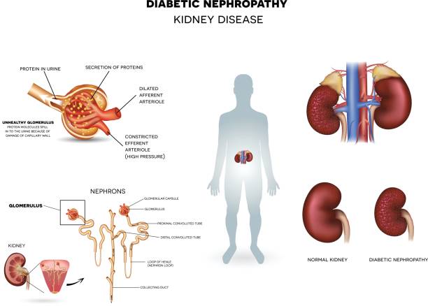 Diabetic Kidney Disease