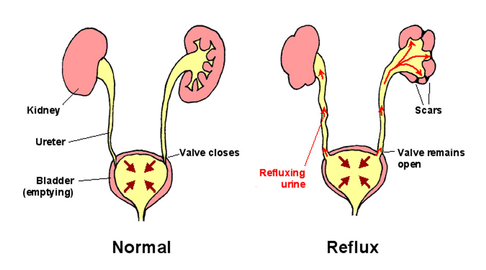 Diabetic Kidney Disease